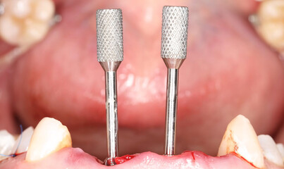 All on four full arch dental implants for edentulous jaws. Treatment involves a full jaw prosthesis...