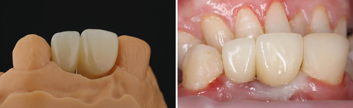 Dental implant surgery for missing anterior incisors. Treatment includes front tooth implant placement and implant-supported zirconium dental prostheses.