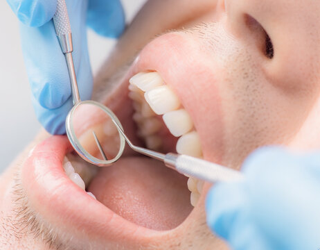 Dentist examining a patient&rsquo;s teeth with dental instruments in a clinic.
