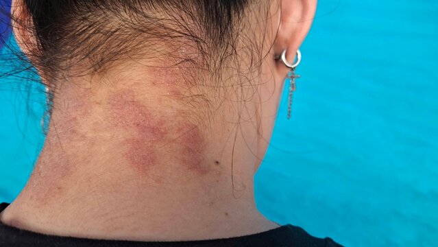 portrait the rash and hives, reaction and urticaria, eczema and epidermis, allergic and psoriasis, inflammation skin on the neck, health care and  medical concept.