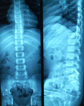 X-ray of the human lumbo sacral spine. Lumber lordosis is lost may be due to muscle spasm. 