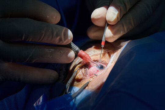 Ophthalmic surgeon performing cataract surgery with intraocular lens implantation, close-up of eye microsurgery in operating room.