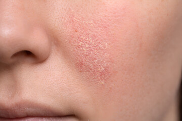 Fototapeta premium Photorealistic dermatology clinical close-up of the nasolabial fold area showing mild seborrheic dermatitis: subtle pink-red patch along the fold with fine slightly greasy scale