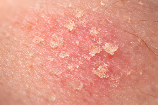 Photorealistic dermatology clinical close-up of the nasolabial fold area showing mild seborrheic dermatitis: subtle pink-red patch along the fold with fine slightly greasy scale