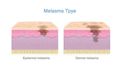 Skin layer with Epidermal melasma and Dermal melasma. Medical diagram about the different types of anatomy of skin pigment with dark spots problem and skin uneven.