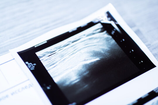 Medical sonogram photograph portraying fetal profile with clinical borders and emotional tone