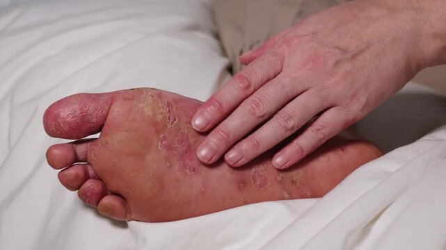 Woman showing her damaged sole. Red wounds on female skin after several confluent blisters of eczema. Acute psoriasis, chemical irritation, allergic reaction, dermatological disease on female foot.