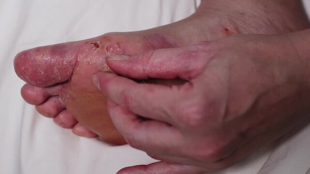 Woman scratching her sole with her finger. Huge wound on female foot after several confluent blisters of eczema. Acute psoriasis, chemical irritation, allergic reaction, dermatological disease on foot
