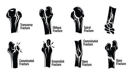 Set of human bone fracture types including transverse oblique spiral greenstick and comminuted