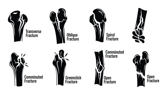 Set of human bone fracture types including transverse oblique spiral greenstick and comminuted