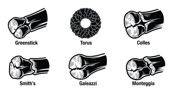 Common types of bone fractures with names including greenstick torus colles smiths galeazzi and monteggia