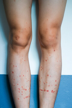 Insect Bites Causing Red Bumps on Legs from Black Flies Outdoor Environment Close-Up Perspective Exploring Skin Reactions to Insect Stings