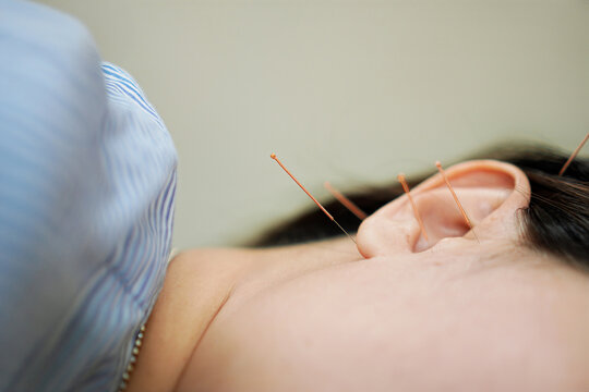 Auricular Acupuncture Therapy on Ear