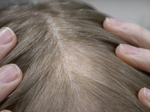 Baldness at the parting, a woman loses hair on her head