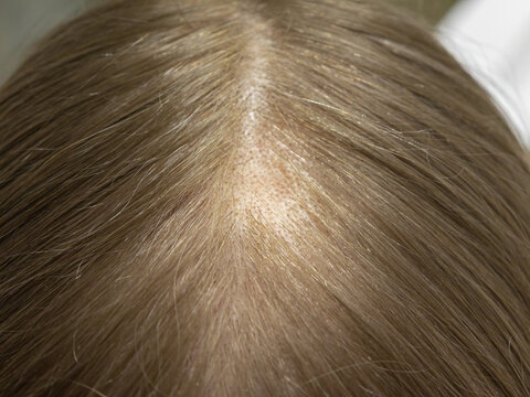 Androgenetic alopecia in women, hair loss around the parting