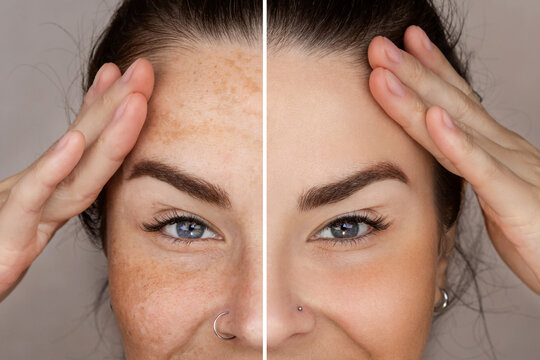 Caucasian woman's face before and after procedure removing pigment from the skin, use cream, laser, LPL, with and without freckles or age spots, cropped, close up