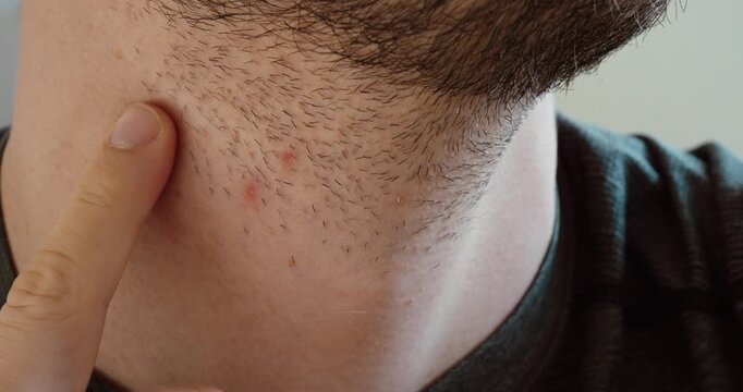 Close-up of razor bumps and skin irritation on a man&rsquo;s neck after shaving.