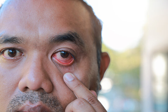 Close up of an Asian man pulling down his lower eyelid with his finger to show a red, bloodshot and inflamed eye. Concept of pink eye, conjunctivitis, allergy, infection and medical eye care.