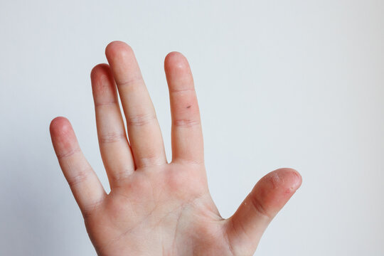 Child hand showing splinter in finger dry skin irritation dermatology concept