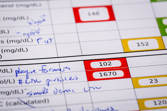 high risk cholesterol  - a detail of blood laboratory screening results with focus on lipids panel with red flags and doctor comments