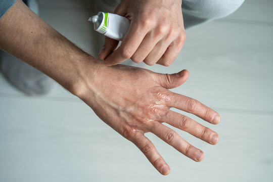 Man applying healing gel on painful areas of hands skin and over knuckles to cure cracks, dryness and lack of water in body, problems with skin caused by winter season and being without gloves in cold