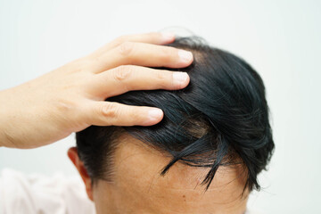 Naklejka premium Bald in the middle head and begin no loss hair glabrous of mature man.