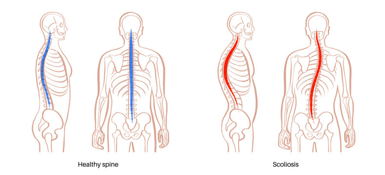 Scoliosis spine deformity