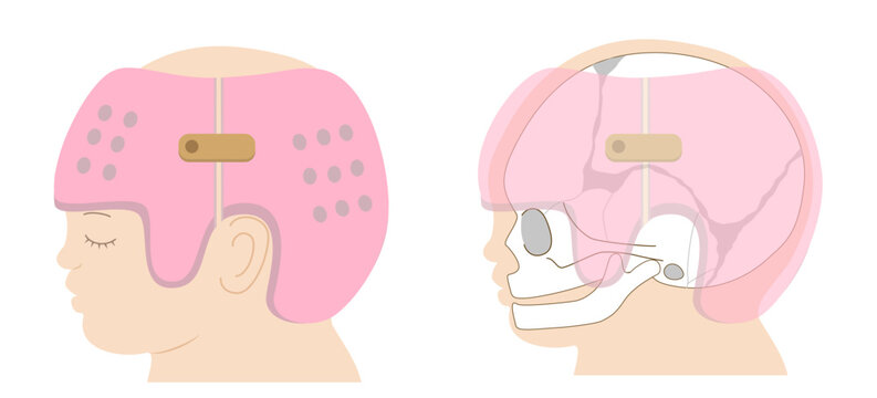 Diagram showing the mechanism of infant cranial correction with helmet therapy