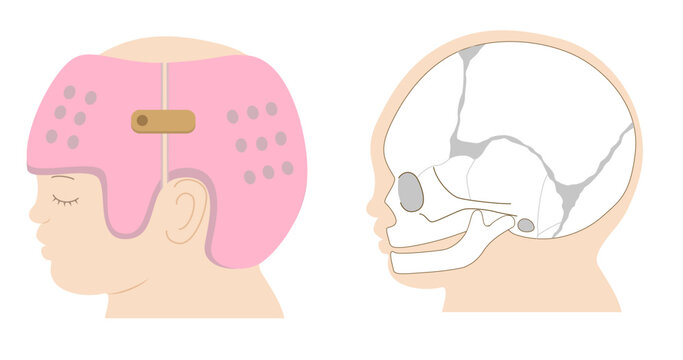 Diagram showing the mechanism of infant cranial correction with helmet therapy