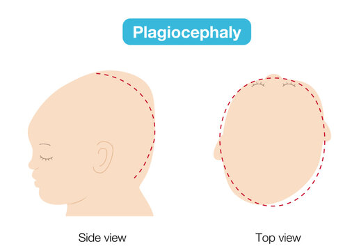babies with plagiocephaly, brachycephaly, and dolichocephaly showing head shape deformities, top and side view