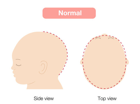 babies with plagiocephaly, brachycephaly, and dolichocephaly showing head shape deformities, top and side view