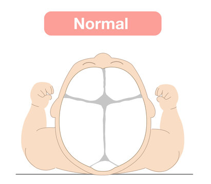 Illustration explaining how sleeping position can cause infant head shape deformities and correct sleeping posture