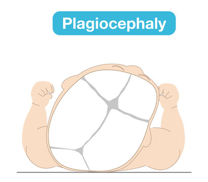 Illustration explaining how sleeping position causes infant head shape deformities such as plagiocephaly, brachycephaly, and dolichocephaly