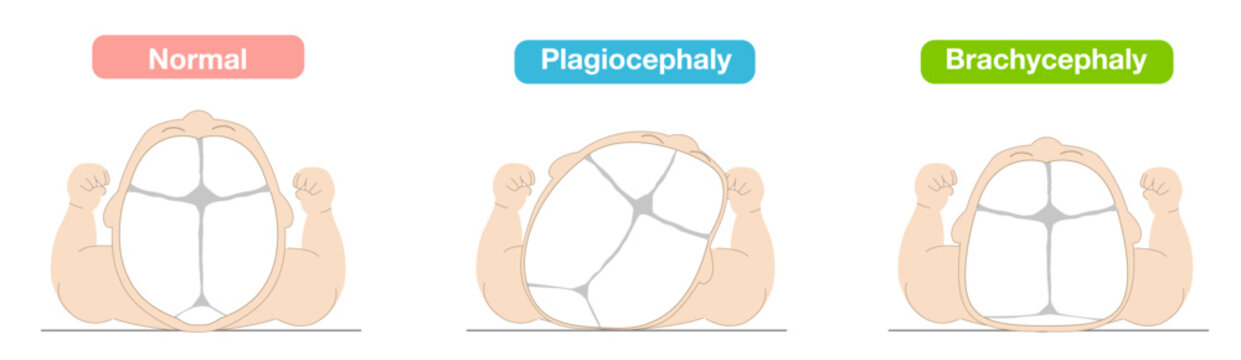Illustration explaining how sleeping position causes infant head shape deformities such as plagiocephaly, brachycephaly, and dolichocephaly