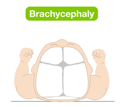 Illustration explaining how sleeping position causes infant head shape deformities such as plagiocephaly, brachycephaly, and dolichocephaly