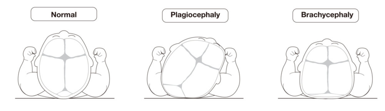 Infant Head Shape Deformities Caused by Sleeping Position &ndash; Plagiocephaly, Brachycephaly, and Dolichocephaly Explained