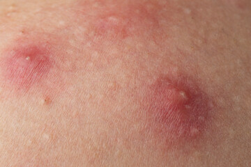 Fototapeta premium Acne on skin closeup photo. Inflamed skin bumps acne macro. Dermatology concept with acne skin pores. Detailed skin with acne.