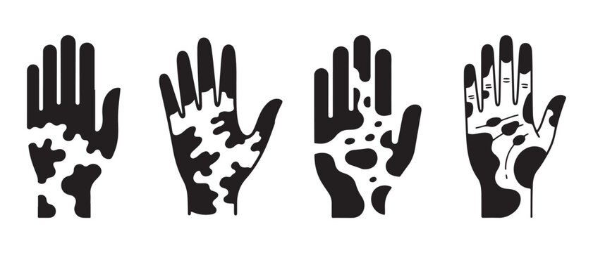 Illustration showing depigmentation patterns on four different hands, representing skin conditions.