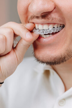Young man inserting clear dental aligner for straight teeth and at-home orthodontic treatment