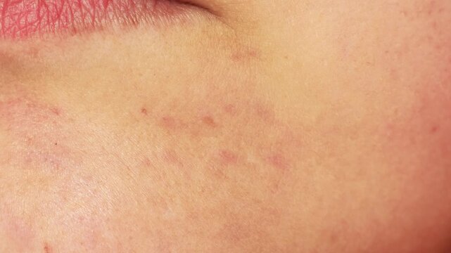 Closeup of blemished skin revealing skin imperfections, flaws and textures