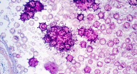 Naklejka premium Microscopic examination of lymphoma cells highlighting structural details in tissue samples for clinical research