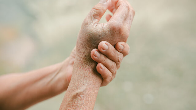 Close up senior woman holding painful wrist with bruising and swelling. Elderly hand injury and joint pain concept, healthcare and medical treatment for arthritis, trauma, and chronic inflammation.
