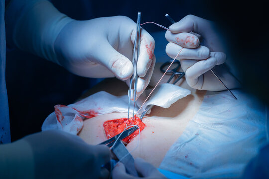 Surgeons performing complex surgical procedure umbilical hernia removal in operating room