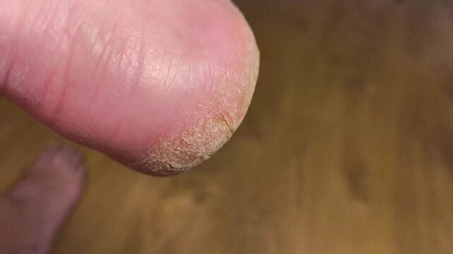 Authentic real life extreme close-up of a dry severely cracked heel on an elderly person foot dermatology healthcare and medical foot care problem real footage no ai