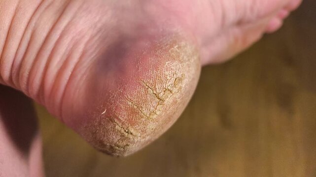 Authentic real life extreme close-up of a dry severely cracked heel on an elderly person foot dermatology healthcare and medical foot care problem real footage no ai