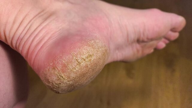 Authentic real life extreme close-up of a dry severely cracked heel on an elderly person foot dermatology healthcare and medical foot care problem real footage no ai