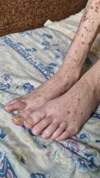 Side view of elderly feet resting on a bed, showing skin with pronounced hyperpigmentation and onychomycosis on the big toe. The feet lie on floral patterned bedding in a home setting.