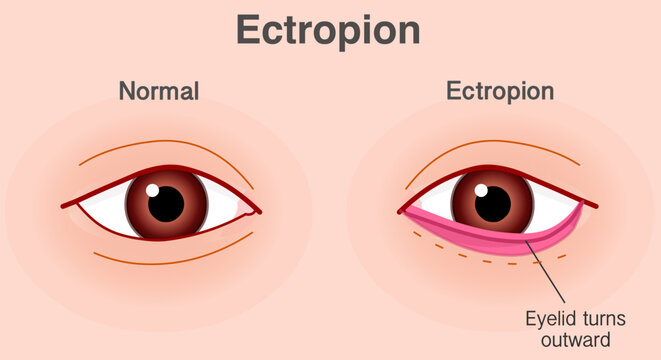Ectropion is a condition that occurs when your eyelid turns outward away from your eyeball. Irritable, red and sore eyes. Illustration vector