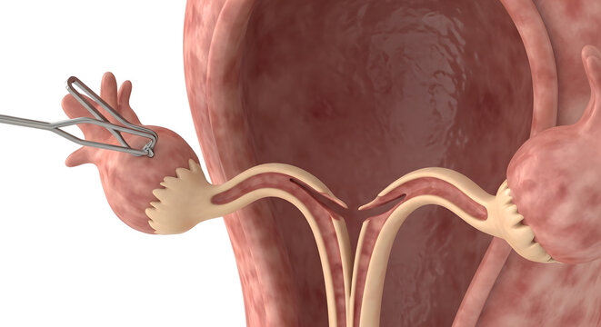 A close-up of a fallopian tube with a surgical instrument