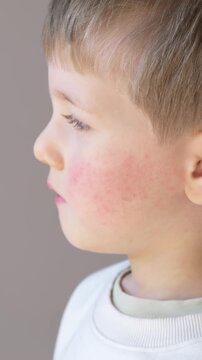 Little boy with red cheeks and visible rash showing allergy, atopic dermatitis, parvovirus B19 or erythema infectiosum. Pediatric concept with skincare treatment using creams and ointments. 
